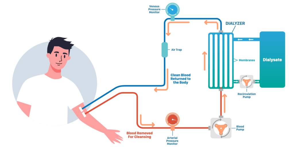 Simplified description of a dialysis setup