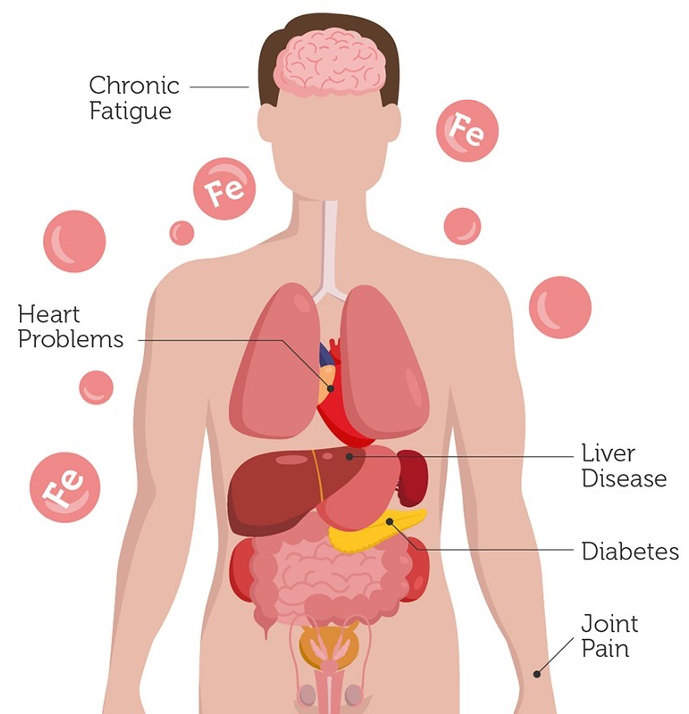 Secondary Hemochromatosis MexBrain